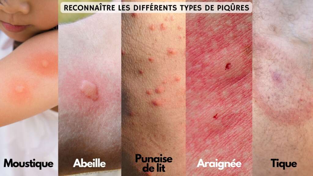 Reconnaître les différents types de piqûres